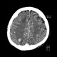 Metastasis in brain, multiple, multiple myeloma: CT - Computed tomography